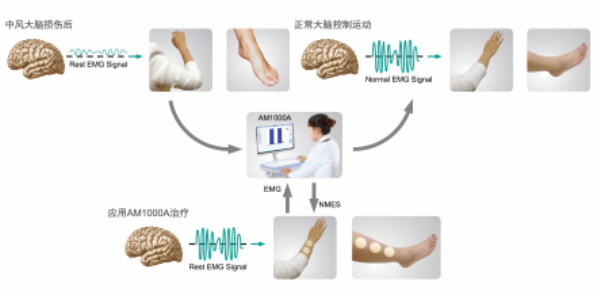 聊聊神经康复治疗中的肌电生物反馈疗法