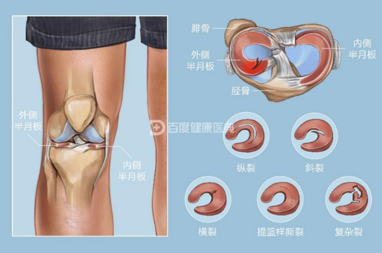 半月板损伤电磁式冲击波治疗方案案例分享