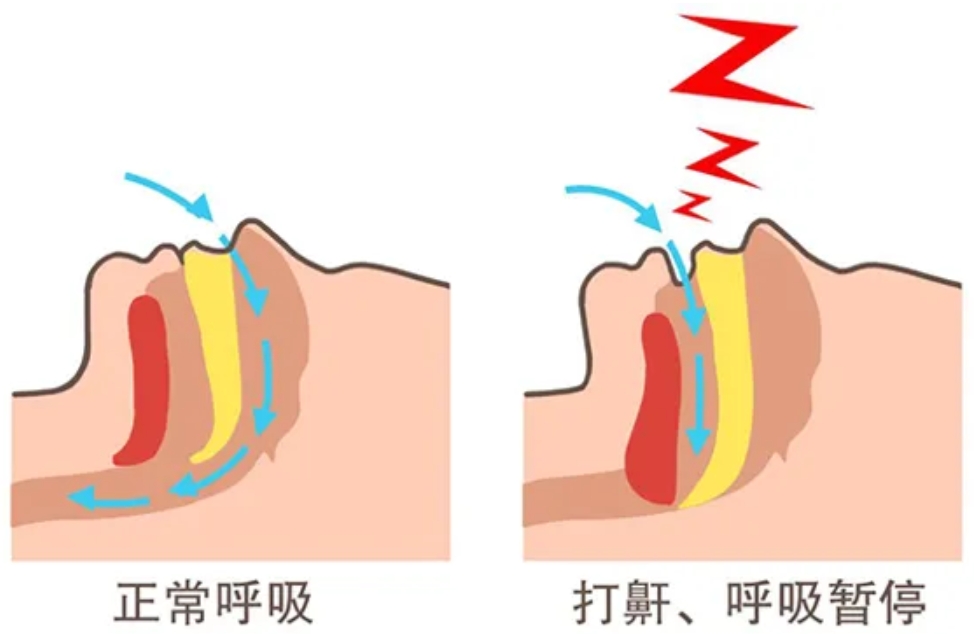 打呼噜到底要不要带呼吸机？53岁演员黄磊戴呼吸机睡觉，引发热议~