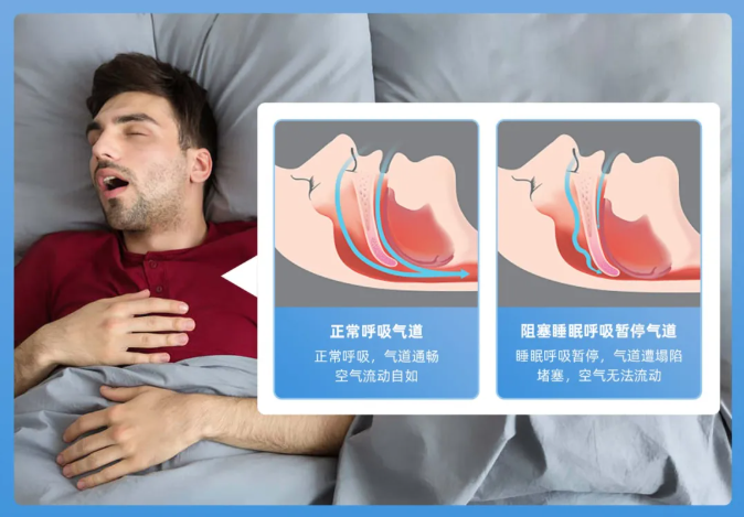 睡眠呼吸暂停OSA