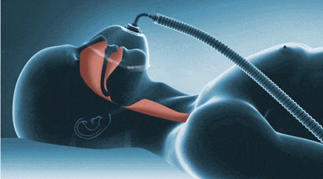 睡眠呼吸暂停OSA